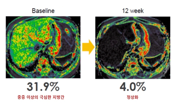비만 동반 비알코올성지방 환자 대상 임상 1상을 통해 자기공명영상-양자밀도 지방비율(MRI-PDFF) 검사로 확인한 랩스트리플아고니스트(LAPS Triple Agonst) 효과. 투여 환자 대부분 3개월 이내 30% 이상 지방간 감소를 보였다. (사진=한미약품)