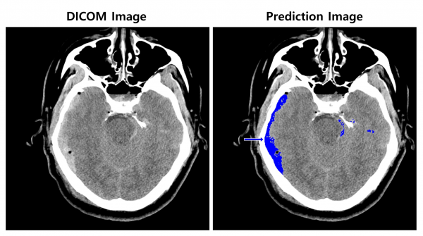 뇌출혈이 의심되는 환자의 뇌 CT 영상(왼쪽)과 뇌출혈 영상 판독 AI모델이 출혈 병변(화살표) 존재와 위치를 식별한 영상. (사진=SK(주) C&C)
